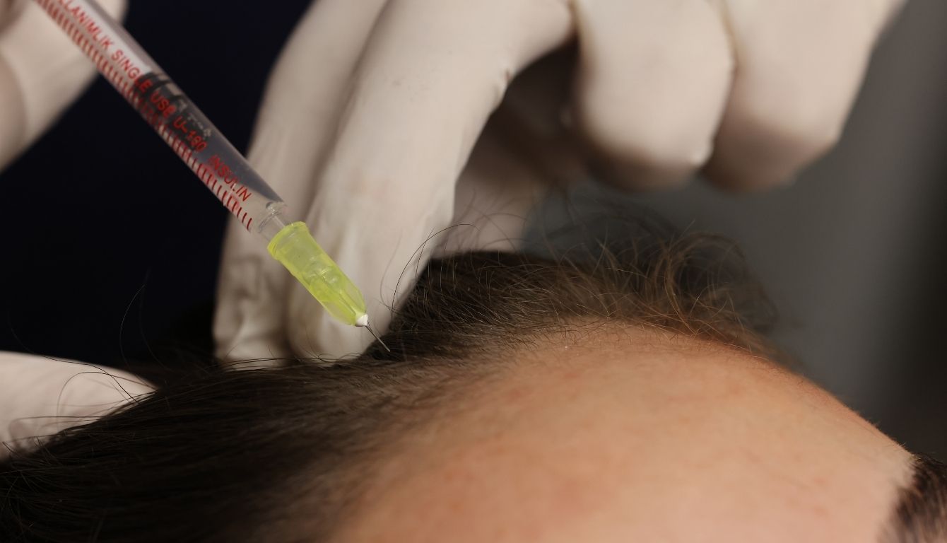 Mesotherapy Applications – Hair Mesotherapy
